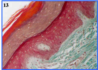 Epitelio pluriestratificado plano queratinizado