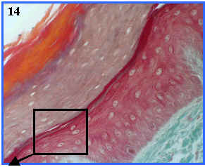 Epitelio pluriestratificado plano queratinizado